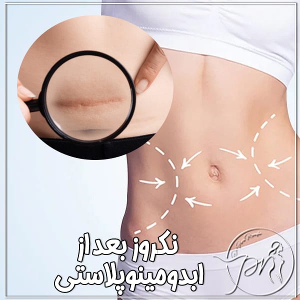 نکروز بعد از ابدومینوپلاستی - دکتر پریا روانفر
