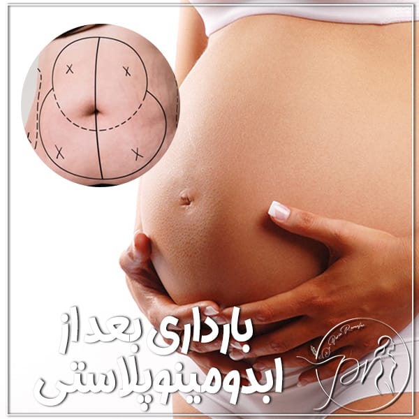بارداری بعد از ابدومینوپلاستی - دکتر پریا روانفر