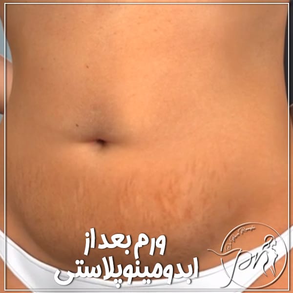 ورم بعد از ابدومینوپلاستی - دکتر پریا روانفر