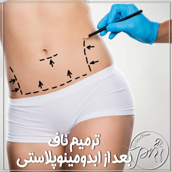ترمیم ناف بعد از عمل ابدومینوپلاستیترمیم ناف بعد از عمل ابدومینوپلاستی _ دکتر پریا روانفر