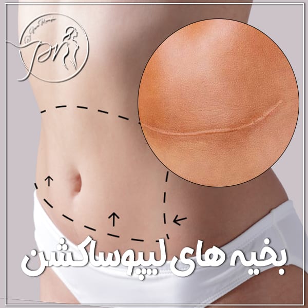 بخیه های لیپوساکشن - دکتر پریا روانفر