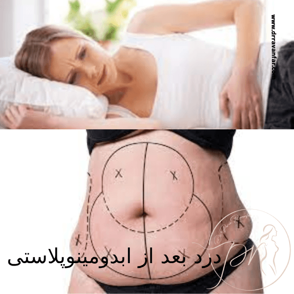 درد بعد از ابدومینوپلاستی - دکتر پریا روانفر