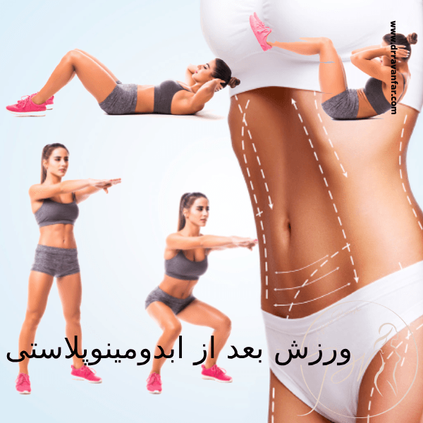 ورزش بعد از عمل ابدومینوپلاستی - دکتر پریا روانفر