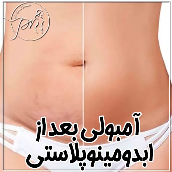 آمبولی بعد از ابدومینوپلاستی - دکتر پریا روانفر