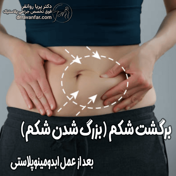 برگشت شکم بعد از ابدومینوپلاستی - دکتر پریا روانفر