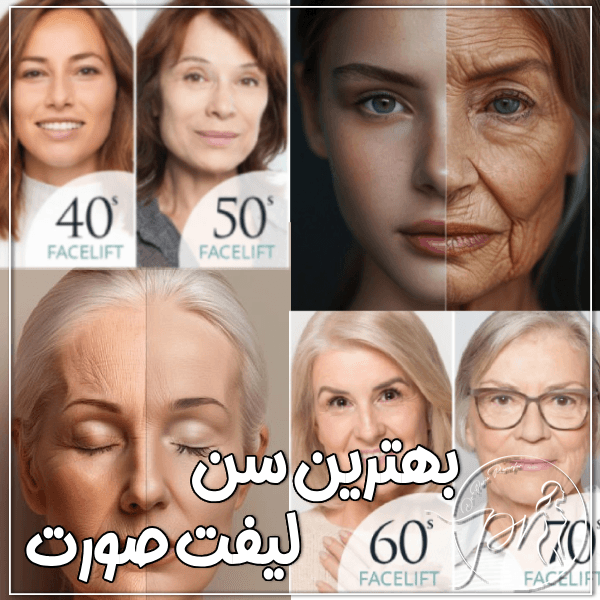 بهترین سن لیفت صورت - دکتر پریا روانفر
