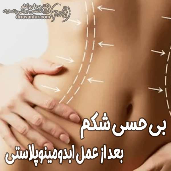 بی‌ حسی شکم بعد از ابدومینوپلاستی - دکتر پریا روانفر