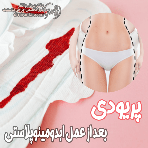 پرویدی بعد از ابدومینوپلاستی -دکتر پریا روانفر